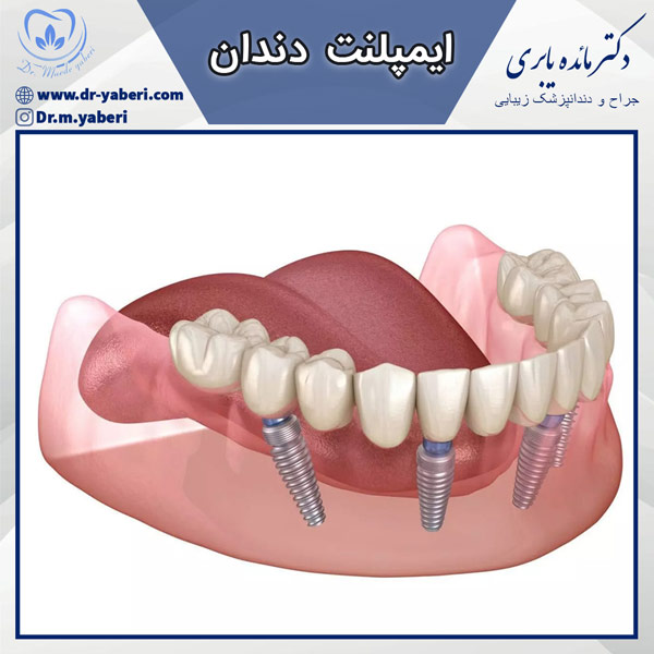 عکس ایمپلنت دندان