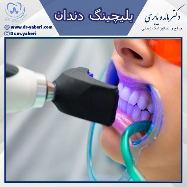 بلیچینگ دندان - دکتر یابری