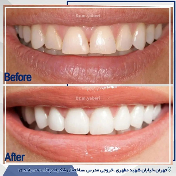 عکس قبل و بعد کامپوزیت دندان - دکتر مائده یابری