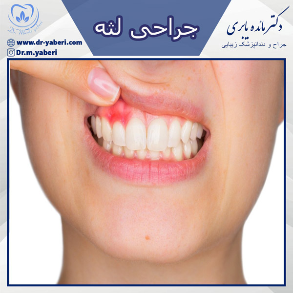 عکس جراحی لثه - دکتر یابری