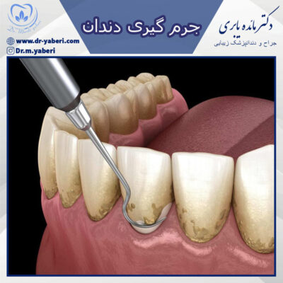 جرم گیری دندان - دکتر یابری