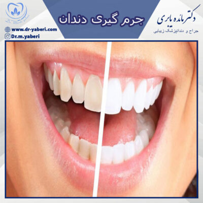 جرم گیری دندان - دکتر یابری