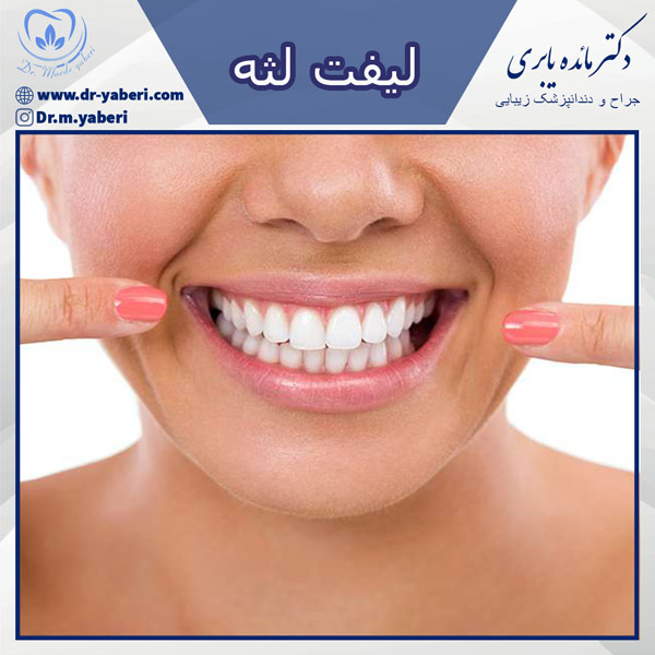 عکس لیفت لثه