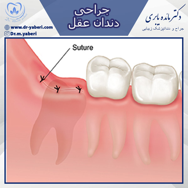 عکس جراحی دندان عقل - دکتر یابری