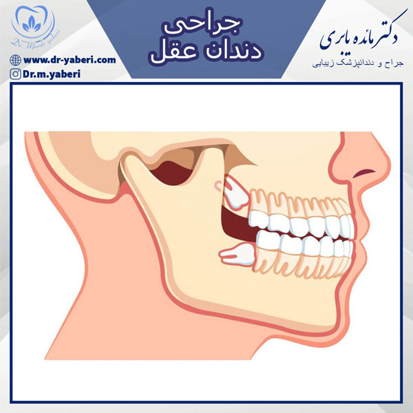 عکس جراحی دندان عقل - دکتر یابری