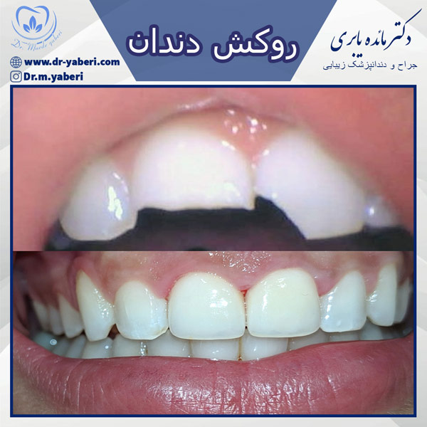 عکس قبل و بعد روکش دندان - دکتر مائده یابری