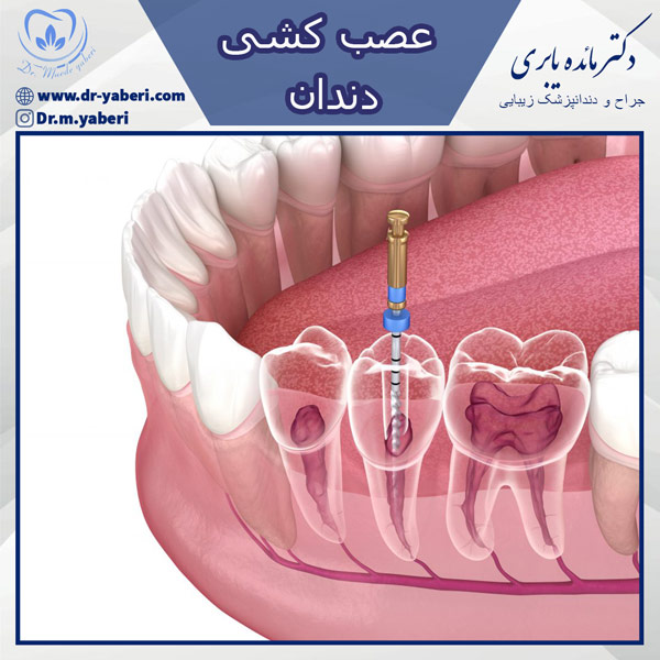 عصب کشی دندان - دکتر یابری