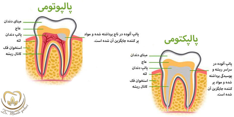 پالپوتومی - دکتر یابری