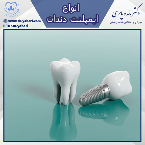 انواع ایمپلنت دندان - دکتر یابری