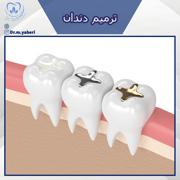 ترمیم دندان - دکتر یابری