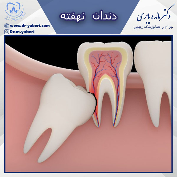 دندان نهفته - دکتر مائده یابری