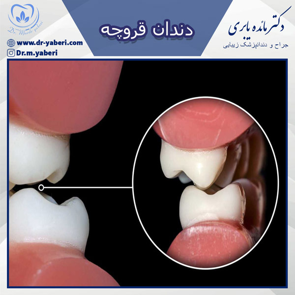 دندان قروچه - دکتر مائده یابری
