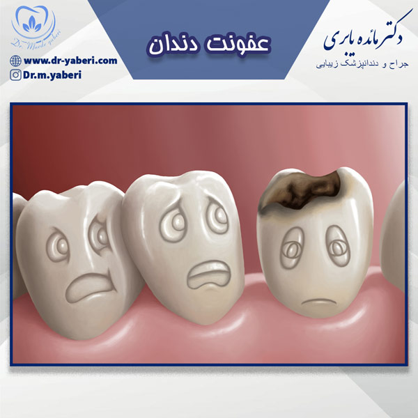 عفونت دندان - دکتر مائده یابری