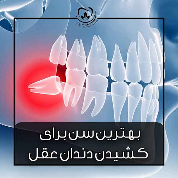 عکس بهترین سن برای کشیدن و جراحی دندان عقل