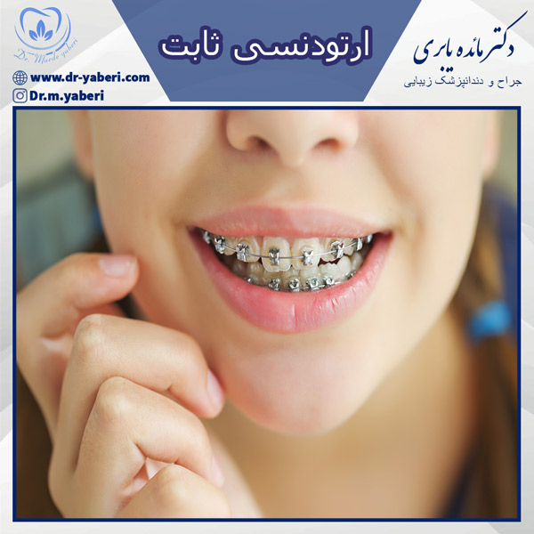 ارتودنسی ثابت - دکتر مائده یابری در تهران