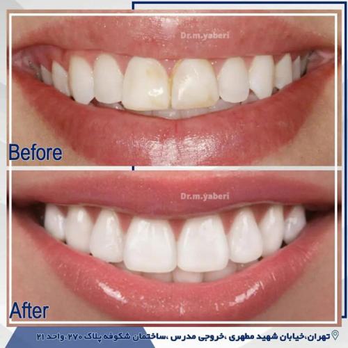 عکس لمینت دندان - دکتر مائده یابری در تهران