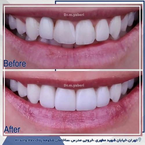عکس لمینت دندان - دکتر مائده یابری در تهران