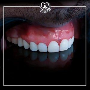 کامپوزیت دندان - دکتر مائده یابری در تهران