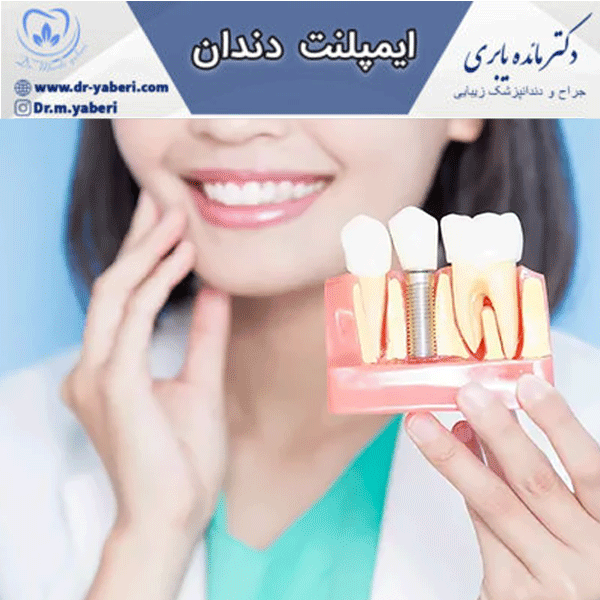 عکس ایمپلنت دندان