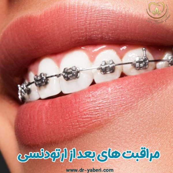 مراقبت های بعد ارتودنسی - دکتر مائده یابری