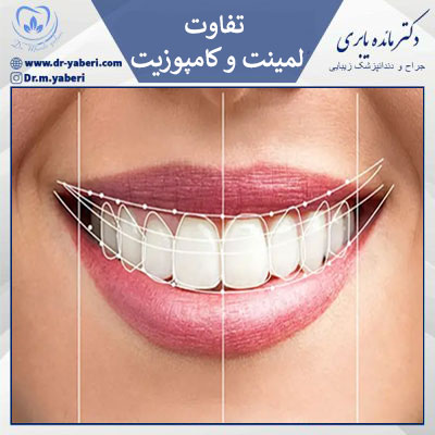 تفاوت لمینت و کامپوزیت - دکتر مائده یابری