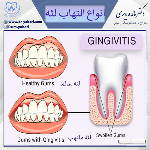 عکس مقایسه التهاب لثه