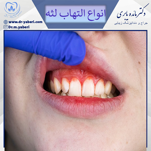عکس التهاب لثه - دکتر مائده یابری
