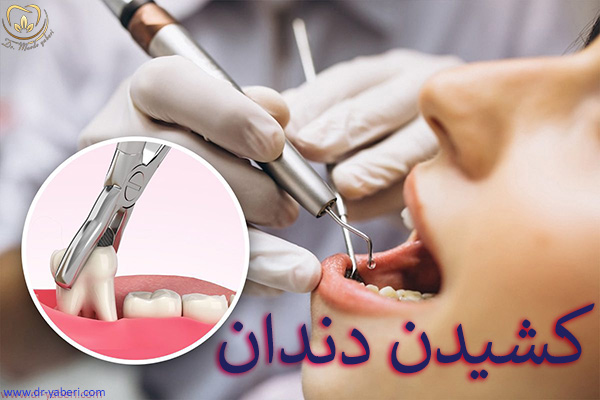 کشیدن دندان - دکتر مائده یابری