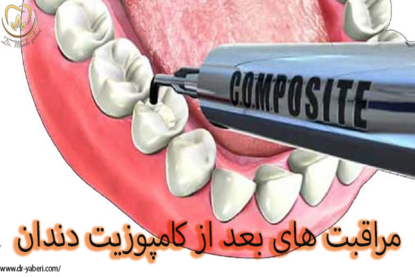 مراقبت های بعد از کامپوزیت دندان - دکتر مائده یابری