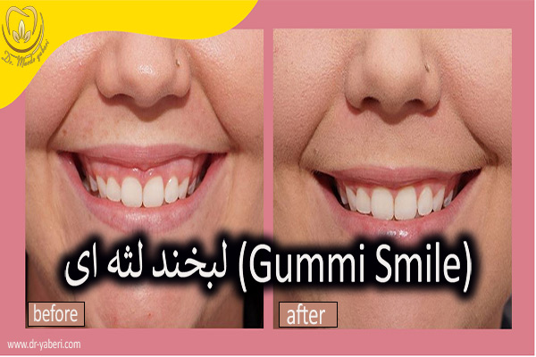 لبخند لثه ای - دکتر مائده یابری