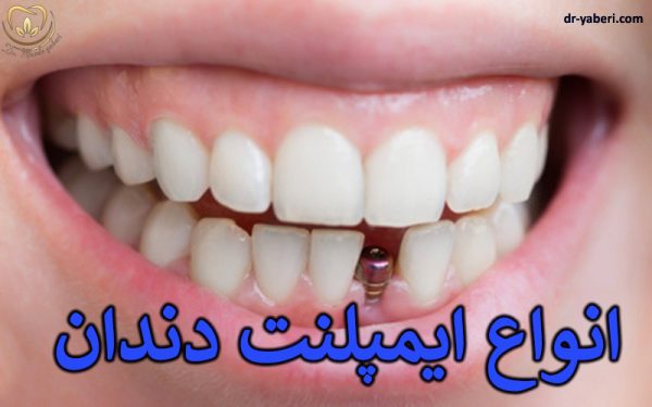 انواع ایمپلنت دندان - دکتر مائده یابری