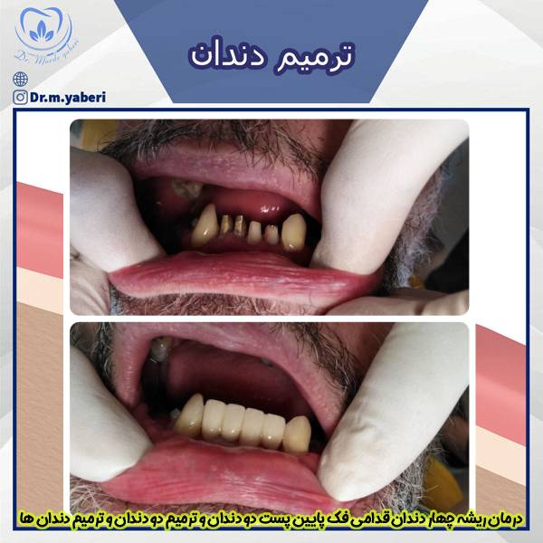 ترمیم دندان - دکتر مائده یابری