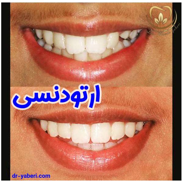 عکس نمونه کار ارتودنسی - دکتر مائده یابری