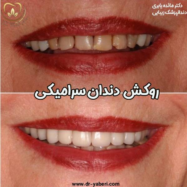 عکس قبل و بعد روکش دندان - دکتر مائده یابری