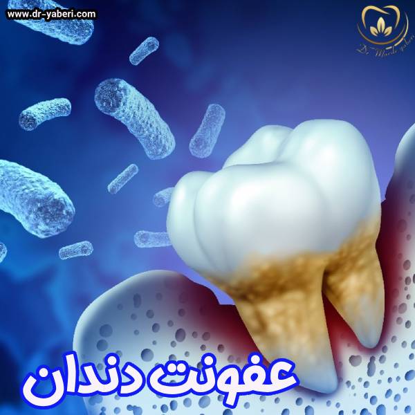 عکس عفونت دندان