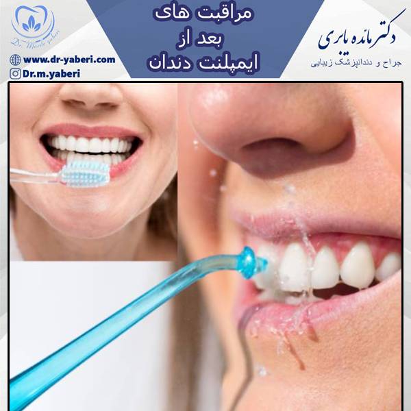 مراقبت های بعد ایمپلنت دندان - دکتر مائده یابری
