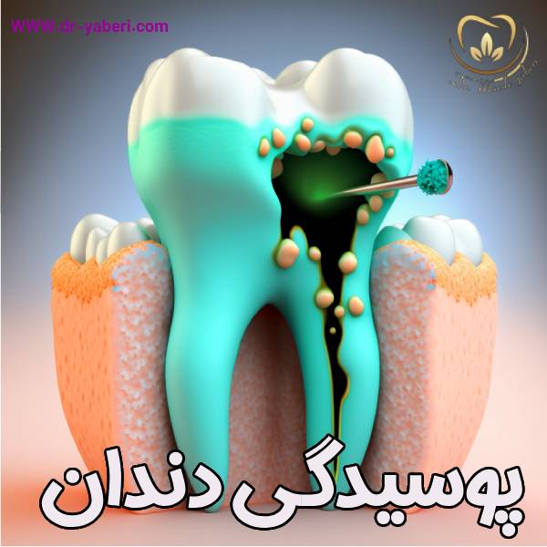عکس پوسیدگی دندان