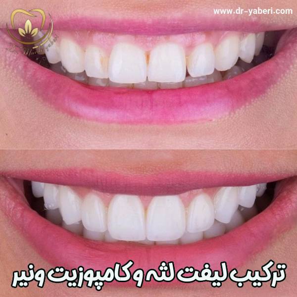 عکس قبل و بعد لیفت لثه