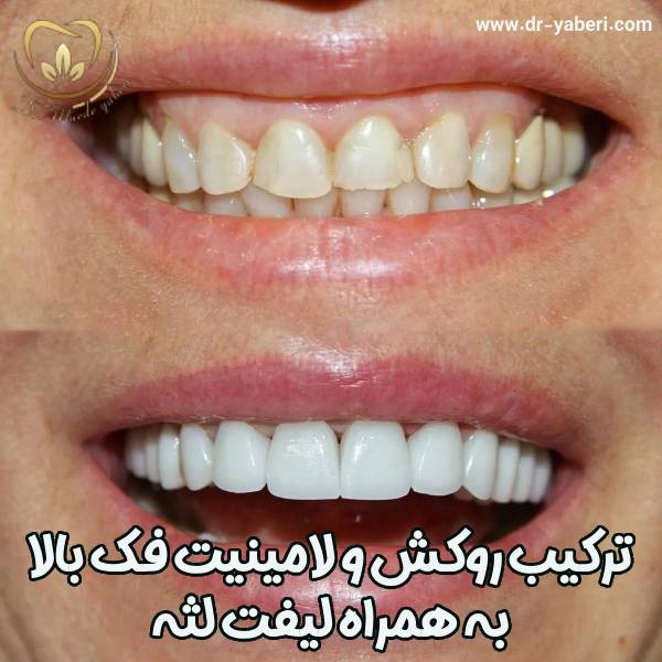 عکس لیفت لثه