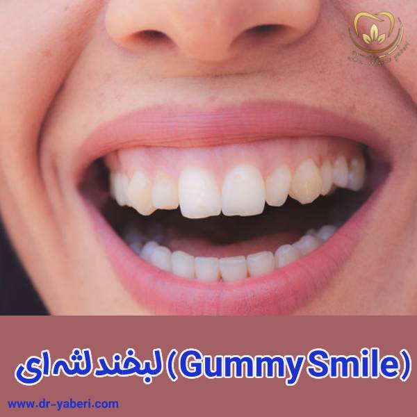 لبخند لثه ای