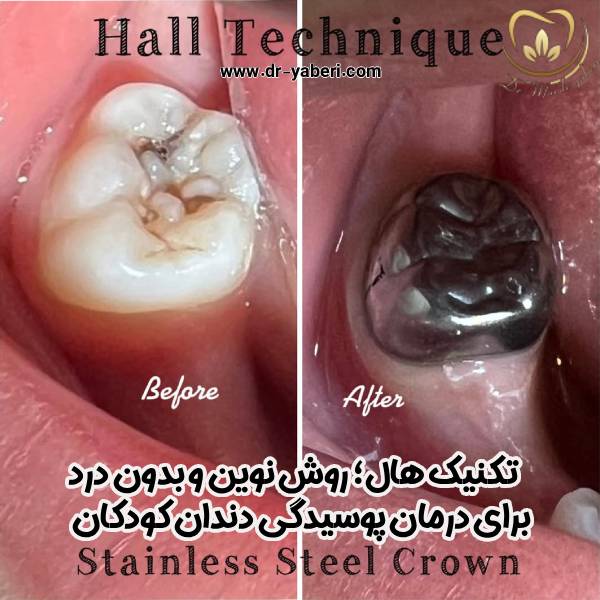 تکنیک هال برای درمان پوسیدگی دندان کودکان - دکتر مائده یابری