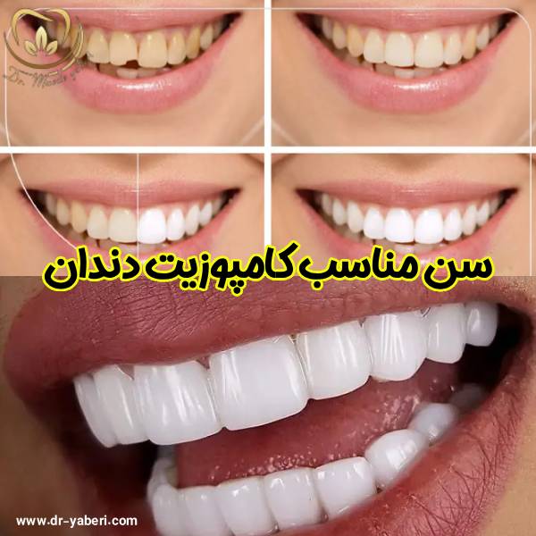 سن مناسب کامپوزیت دندان - دکتر مائده یابری