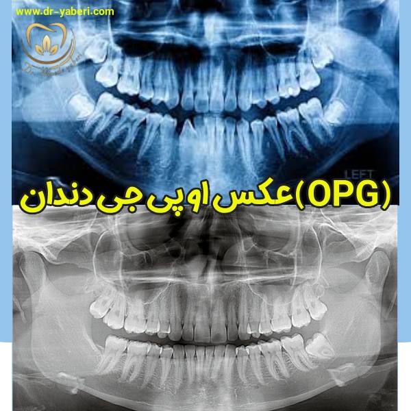 عکس او پی جی دندان - دکتر مائده یابری