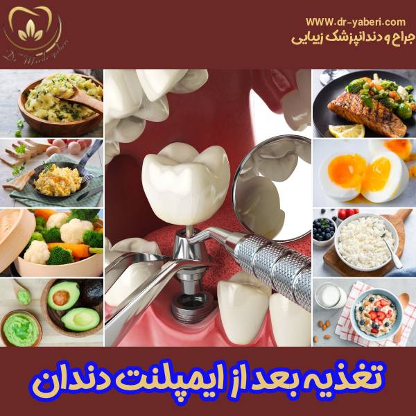 تغذیه بعد ایمپلنت دندان - دکتر مائده یابری