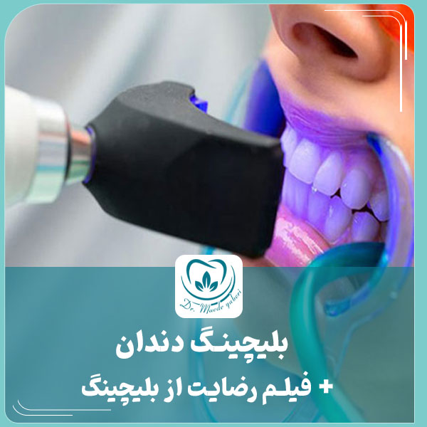 بلیچینگ دندان - دکتر یابری