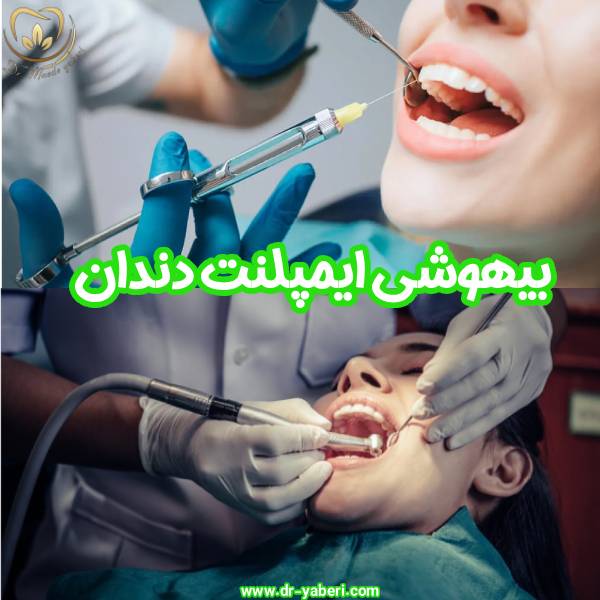 انواع بیهوشی ایمپلنت دندان - دکتر مائده یابری