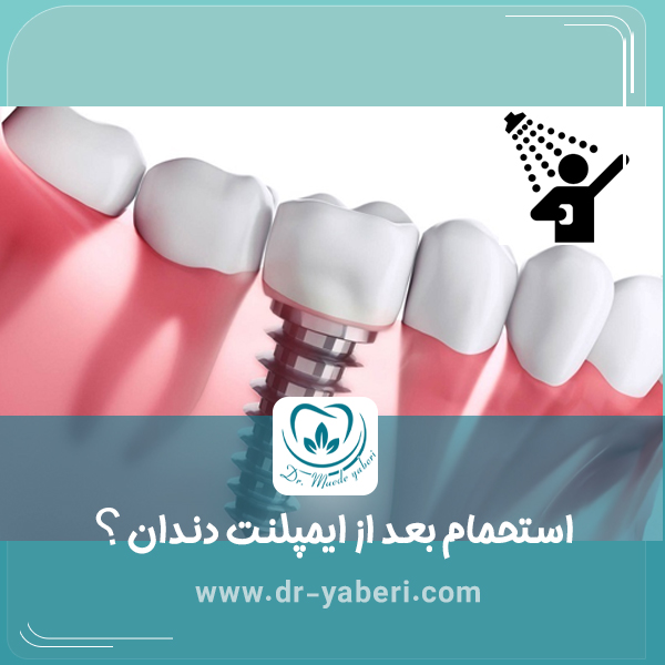 استحمام بعد از ایمپلنت دندان
