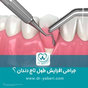 جراحی افزایش طول تاج دندان