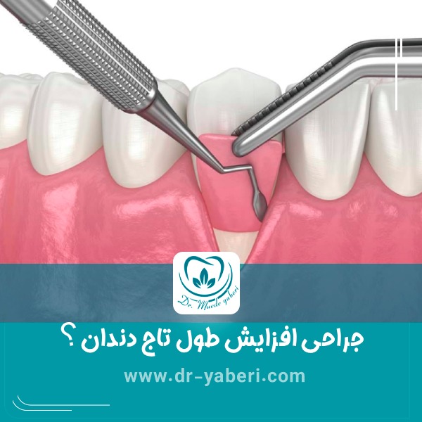 جراحی افزایش طول تاج دندان