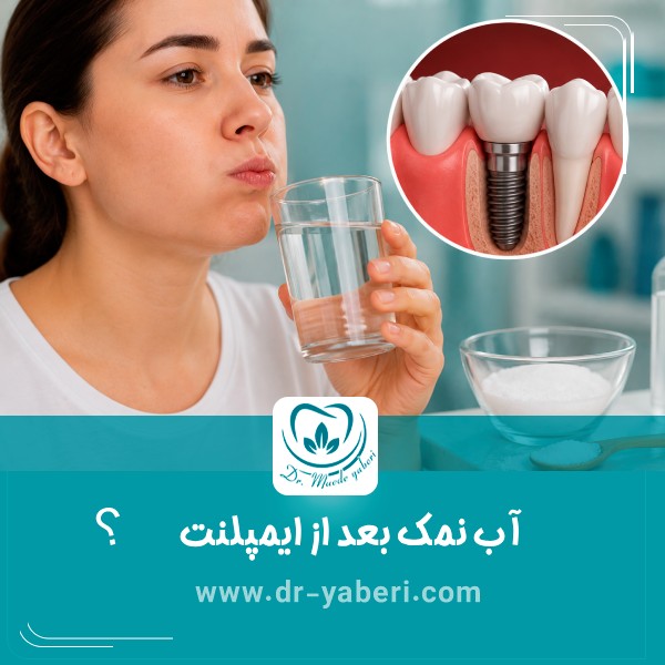 آب نمک بعد از ایمپلنت